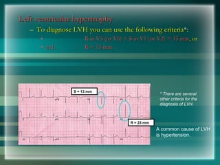 Left ventricular hypertrophy
Left ventricular hypertrophy
– To diagnose LVH you can use the following criteria
To diagnose LVH you can use the following criteria*
*:
:
• R in V5 (or V6) + S in V1 (or V2) > 35 mm
R in V5 (or V6) + S in V1 (or V2) > 35 mm, or
, or
• avL
avL R > 13 mm
R > 13 mm
A common cause of LVH
is hypertension.
* There are several
other criteria for the
diagnosis of LVH.
S = 13 mm
R = 25 mm
 
