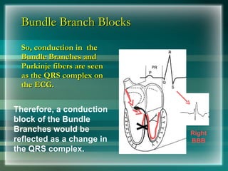 Bundle Branch Blocks
Bundle Branch Blocks
So, conduction in the
So, conduction in the
Bundle Branches and
Bundle Branches and
Purkinje fibers are seen
Purkinje fibers are seen
as the QRS complex on
as the QRS complex on
the ECG.
the ECG.
Therefore, a conduction
block of the Bundle
Branches would be
reflected as a change in
the QRS complex.
Right
BBB
 