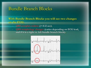 Bundle Branch Blocks
Bundle Branch Blocks
With Bundle Branch Blocks you will see two changes
With Bundle Branch Blocks you will see two changes
on the ECG.
on the ECG.
– QRS complex widens
QRS complex widens (> 0.12 sec)
(> 0.12 sec).
.
– QRS morphology changes
QRS morphology changes (varies depending on ECG lead,
(varies depending on ECG lead,
and if it is a right vs. left bundle branch block)
and if it is a right vs. left bundle branch block).
.
 