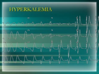 HYPERKALEMIA
HYPERKALEMIA
 
