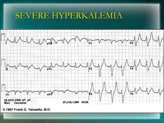 SEVERE HYPERKALEMIA
SEVERE HYPERKALEMIA
 