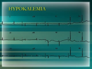 HYPOKALEMIA
HYPOKALEMIA
 