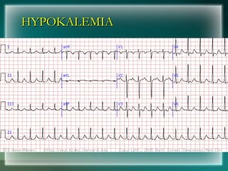 HYPOKALEMIA
HYPOKALEMIA
 