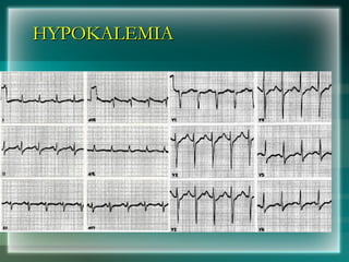 HYPOKALEMIA
HYPOKALEMIA
 