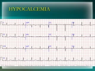 HYPOCALCEMIA
HYPOCALCEMIA
 