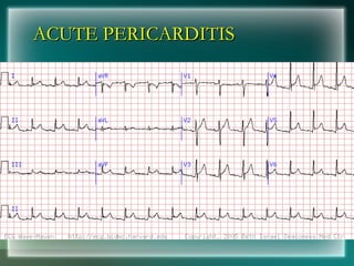 ACUTE PERICARDITIS
ACUTE PERICARDITIS
 