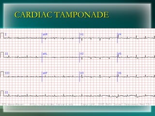 CARDIAC TAMPONADE
CARDIAC TAMPONADE
 