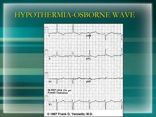 HYPOTHERMIA-OSBORNE WAVE
HYPOTHERMIA-OSBORNE WAVE
 
