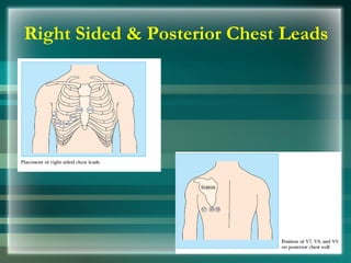 Right Sided & Posterior Chest Leads
 