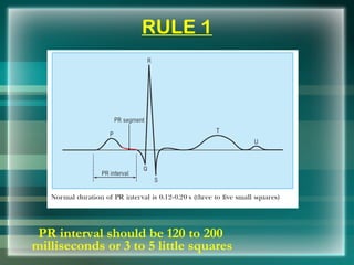 RULE 1
PR interval should be 120 to 200
milliseconds or 3 to 5 little squares
 