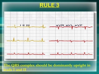 RULE 3
The QRS complex should be dominantly upright in
leads I and II
 