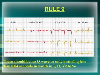 RULE 9
There should be no Q wave or only a small q less
than 0.04 seconds in width in I, II, V2 to V6
 