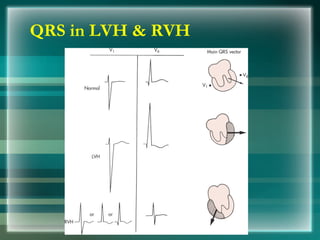 QRS in LVH & RVH
 