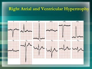 Right Atrial and Ventricular Hypertrophy
 