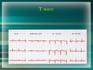 T wave
 