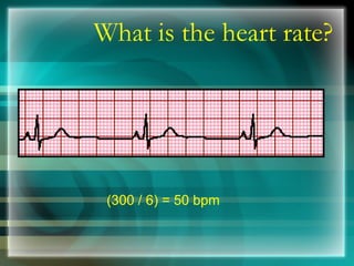 What is the heart rate?
(300 / 6) = 50 bpm
 