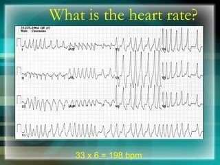 What is the heart rate?
33 x 6 = 198 bpm
 