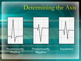 Determining the Axis
Predominantly
Positive
Predominantly
Negative
Equiphasic
 