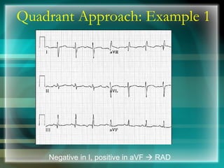 Quadrant Approach: Example 1
Negative in I, positive in aVF  RAD
 