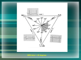 QRS Axis = -30 degrees
 