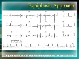 Equiphasic Approach
Equiphasic in aVF  Predominantly positive in I  QRS axis ≈ 0°
 