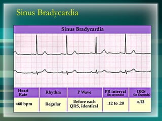 Sinus Bradycardia
 