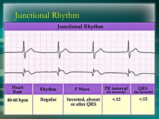 Junctional Rhythm
 