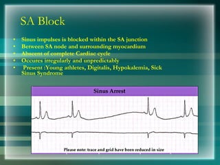 SA Block
• Sinus impulses is blocked within the SA junction
• Between SA node and surrounding myocardium
• Abscent of complete Cardiac cycle
• Occures irregularly and unpredictably
• Present :Young athletes, Digitalis, Hypokalemia, Sick
Sinus Syndrome
 