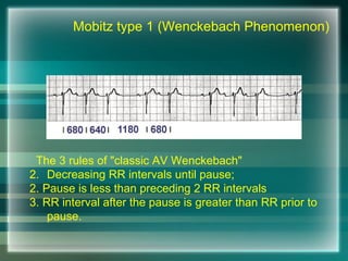 The 3 rules of "classic AV Wenckebach"
2. Decreasing RR intervals until pause;
2. Pause is less than preceding 2 RR intervals
3. RR interval after the pause is greater than RR prior to
pause.
Mobitz type 1 (Wenckebach Phenomenon)
 