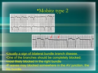 •Mobitz type 2
•Usually a sign of bilateral bundle branch disease.
•One of the branches should be completely blocked;
•most likely blocked in the right bundle
•P waves may blocked somewhere in the AV junction, the
His bundle.
 