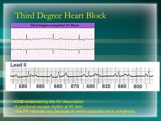 Third Degree Heart Block
•CHB evidenced by the AV dissociation
•A junctional escape rhythm at 45 bpm.
•The PP intervals vary because of ventriculophasic sinus arrhythmia;
 