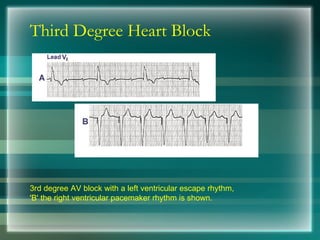 Third Degree Heart Block
3rd degree AV block with a left ventricular escape rhythm,
'B' the right ventricular pacemaker rhythm is shown.
 