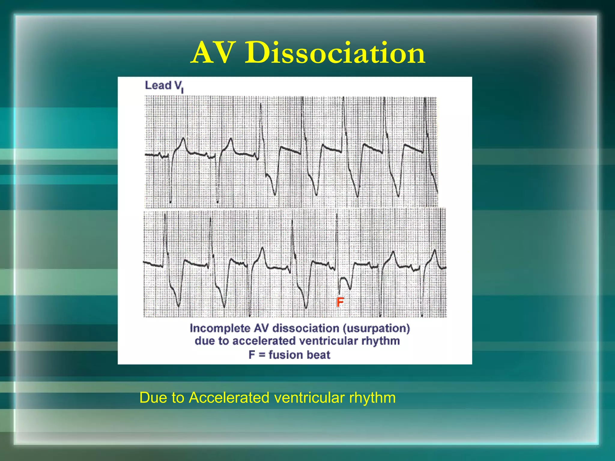 AV Dissociation Due to Accelerated ventricular rhythm 
