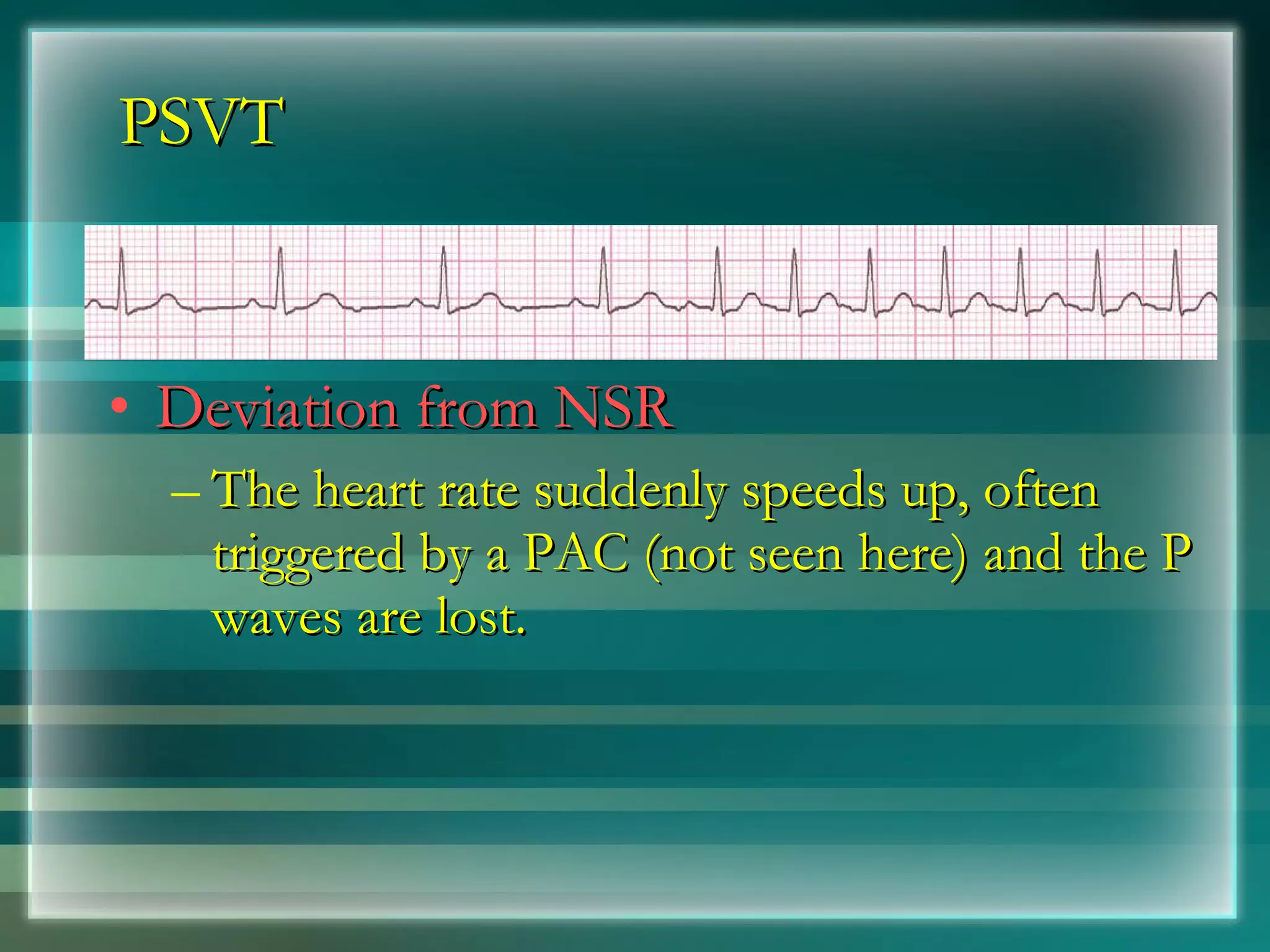 PSVT Deviation from NSR The heart rate suddenly speeds up, often triggered by a PAC (not seen here) and the P waves are lost. 