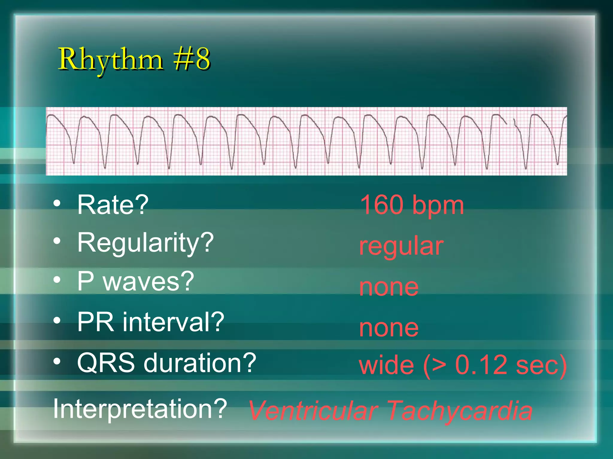 Rhythm #8 160 bpm Rate? Regularity? regular none wide (> 0.12 sec) P waves? PR interval? none QRS duration? Interpretation? Ventricular Tachycardia 