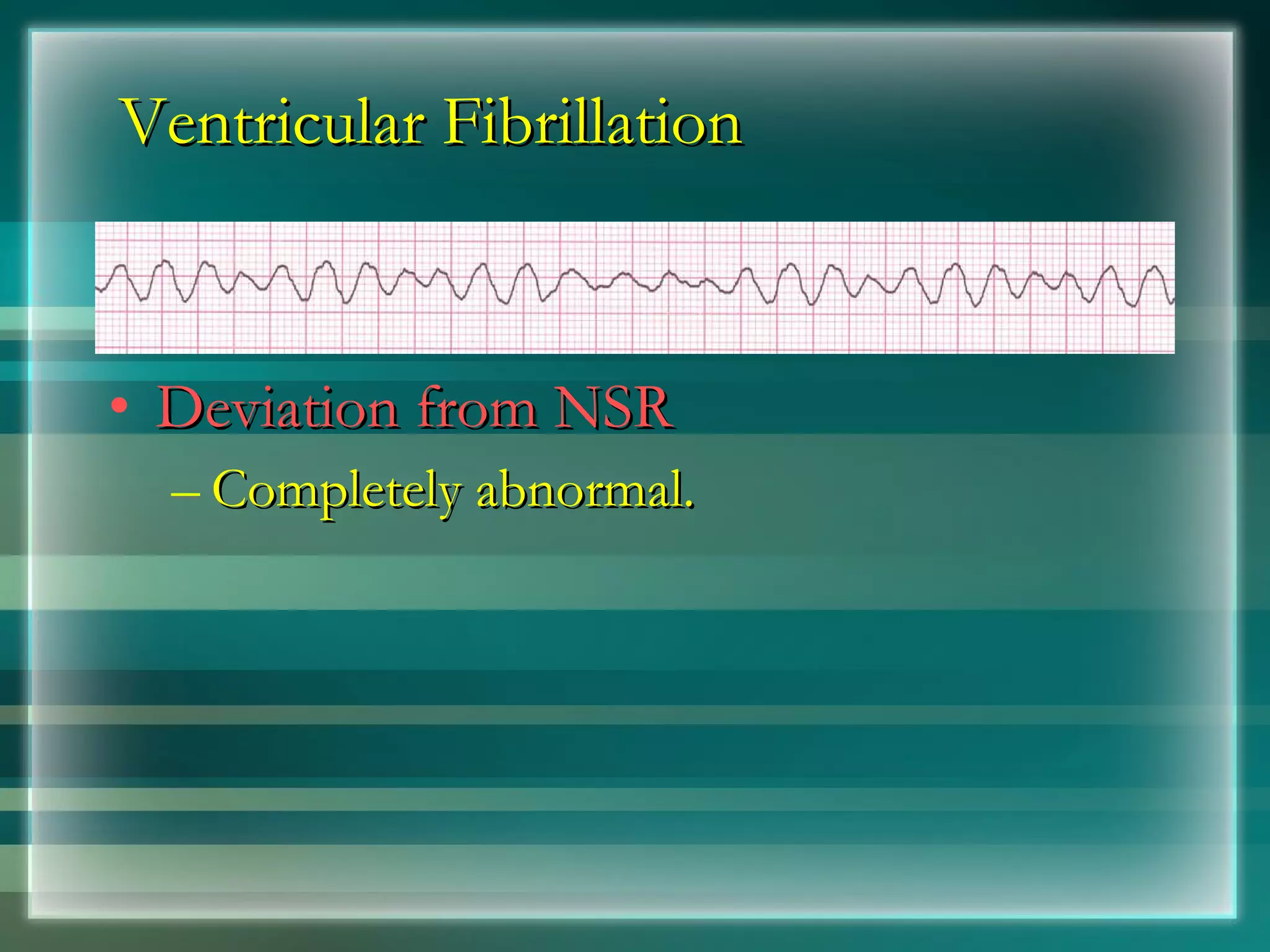 Ventricular Fibrillation Deviation from NSR Completely abnormal. 
