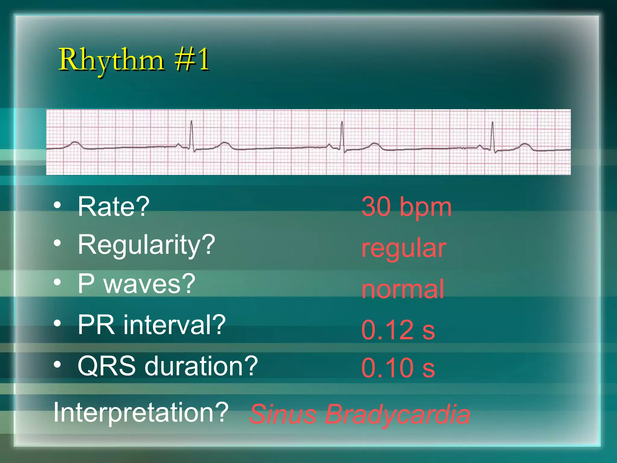 Rhythm #1 30 bpm Rate? Regularity? regular normal 0.10 s P waves? PR interval? 0.12 s QRS duration? Interpretation? Sinus Bradycardia 
