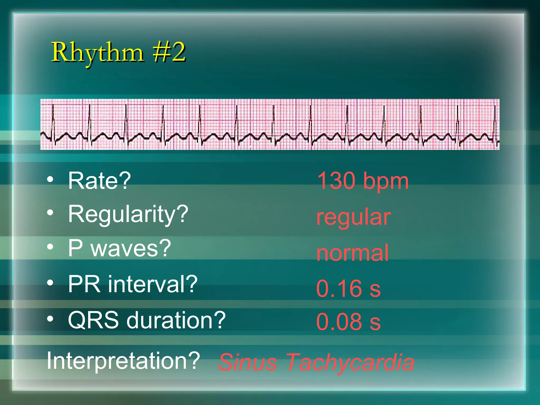 Rhythm #2 130 bpm Rate? Regularity? regular normal 0.08 s P waves? PR interval? 0.16 s QRS duration? Interpretation? Sinus Tachycardia 