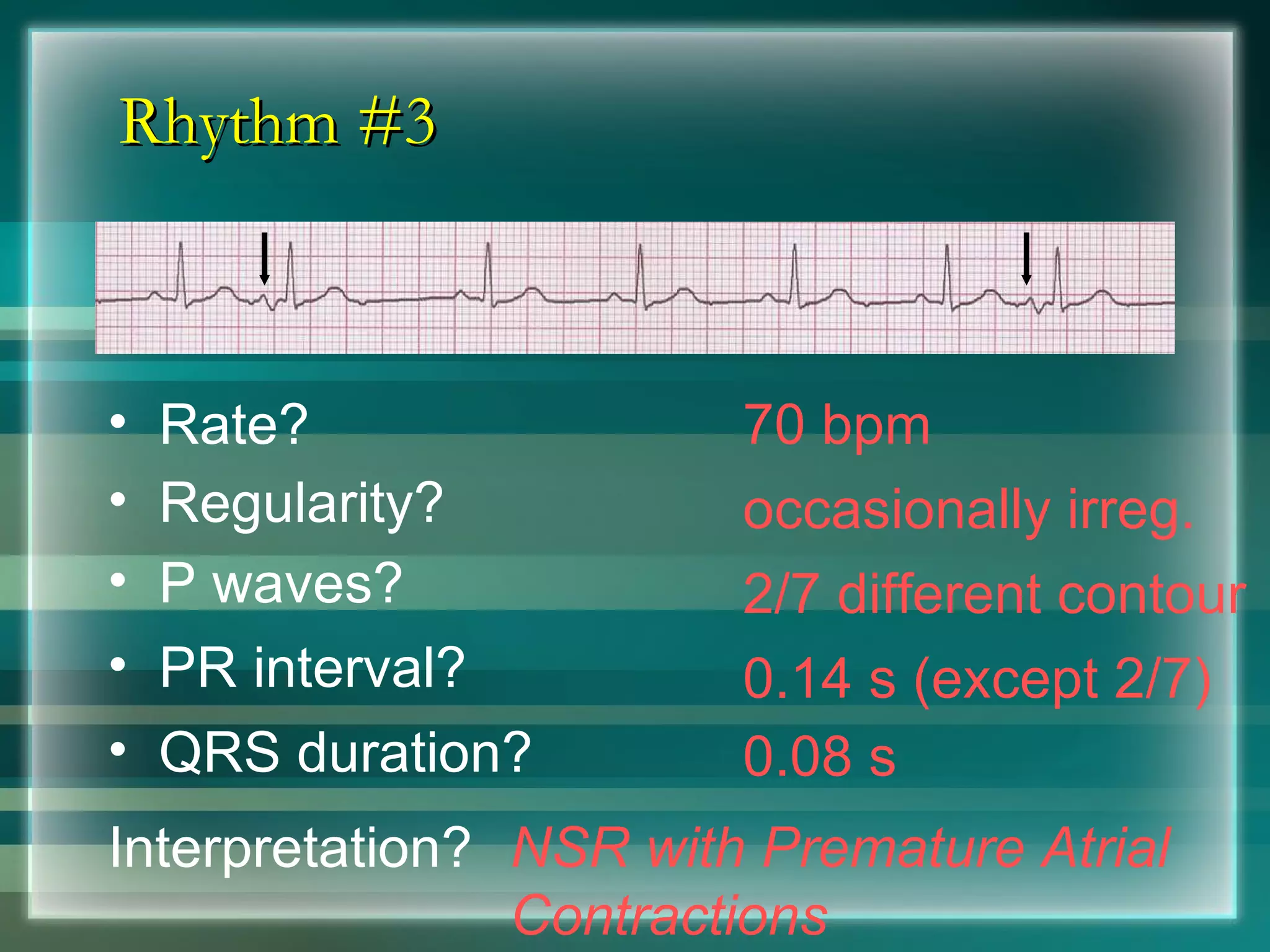 Rhythm #3 70 bpm Rate? Regularity? occasionally irreg. 2/7 different contour 0.08 s P waves? PR interval? 0.14 s (except 2/7) QRS duration? Interpretation? NSR with Premature Atrial Contractions 