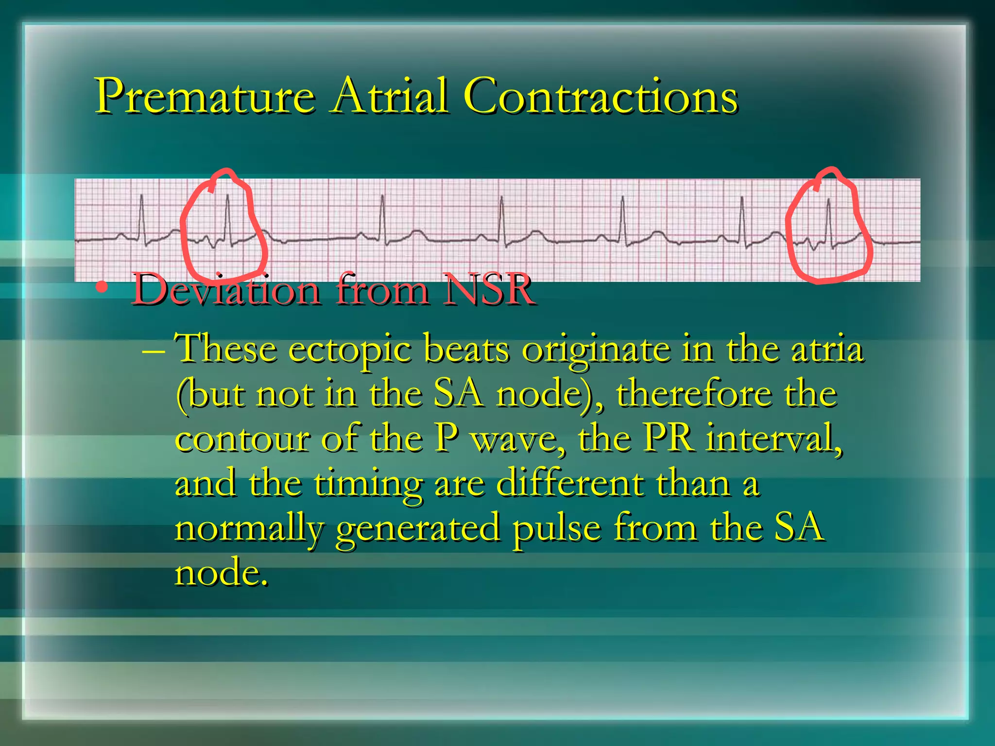 Premature Atrial Contractions Deviation from NSR These ectopic beats originate in the atria (but not in the SA node), therefore the contour of the P wave, the PR interval, and the timing are different than a normally generated pulse from the SA node. 