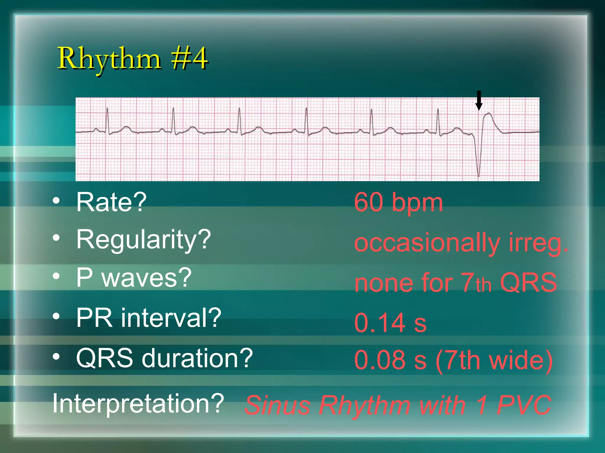 Rhythm #4 60 bpm Rate? Regularity? occasionally irreg. none for 7 th  QRS 0.08 s (7th wide) P waves? PR interval? 0.14 s QRS duration? Interpretation? Sinus Rhythm with 1 PVC 