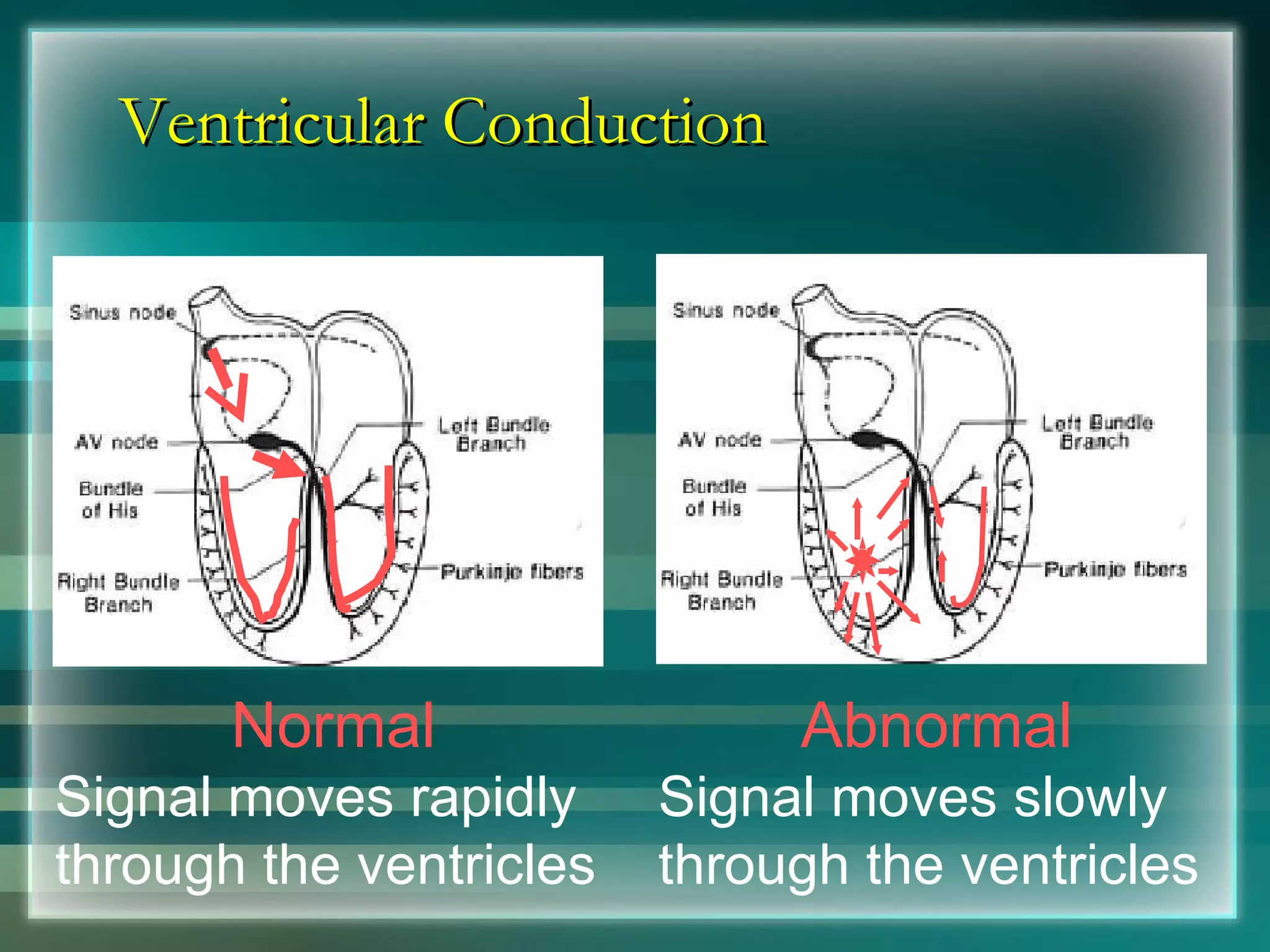 Ventricular Conduction Normal Signal moves rapidly through the ventricles Abnormal Signal moves slowly through the ventricles 