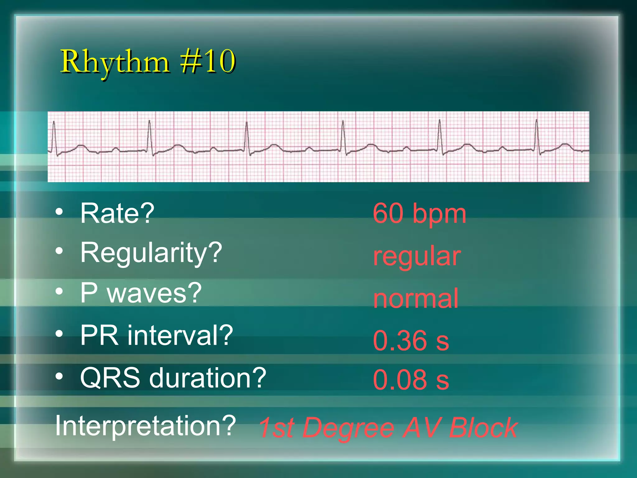 Rhythm #10 60 bpm Rate? Regularity? regular normal 0.08 s P waves? PR interval? 0.36 s QRS duration? Interpretation? 1st Degree AV Block 