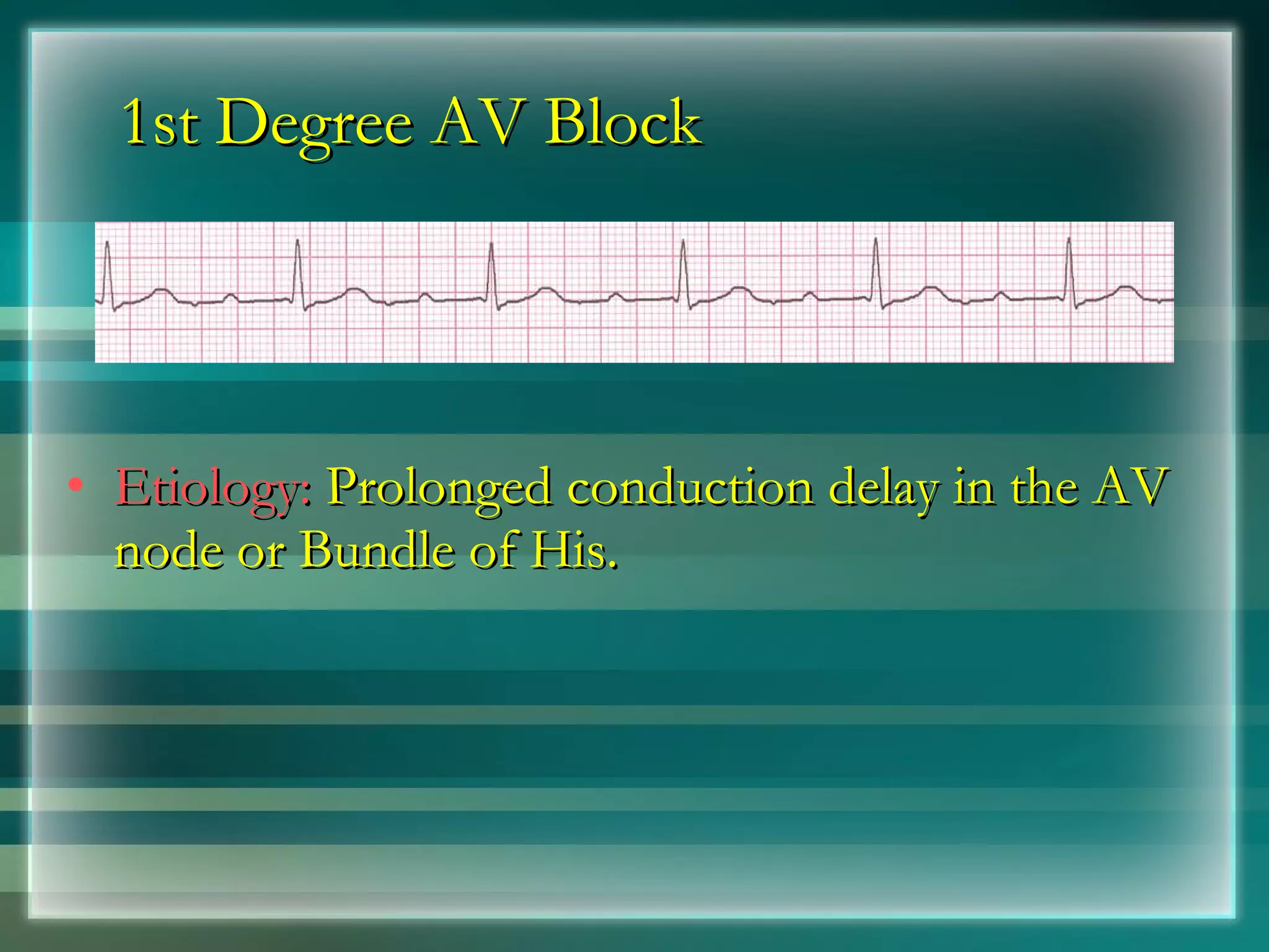 1st Degree AV Block Etiology:  Prolonged conduction delay in the AV node or Bundle of His. 