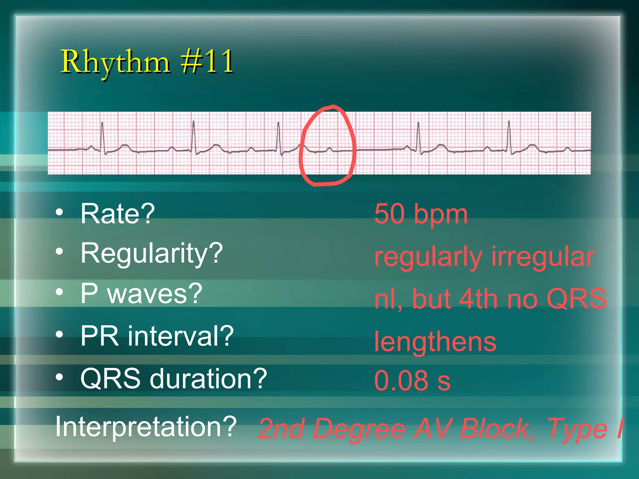 Rhythm #11 50 bpm Rate? Regularity? regularly irregular nl, but 4th no QRS 0.08 s P waves? PR interval? lengthens QRS duration? Interpretation? 2nd Degree AV Block, Type I 