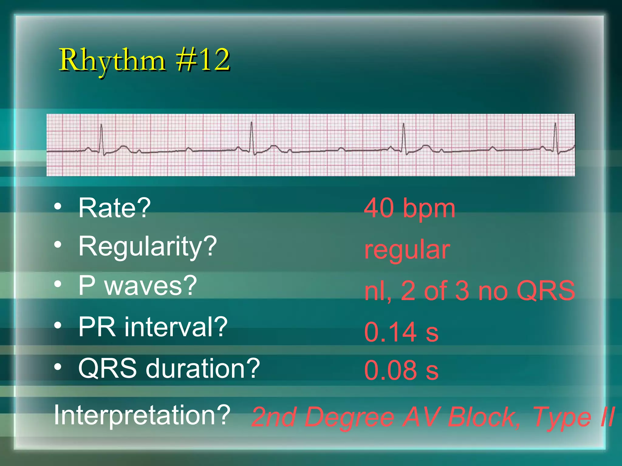 Rhythm #12 40 bpm Rate? Regularity? regular nl, 2 of 3 no QRS 0.08 s P waves? PR interval? 0.14 s QRS duration? Interpretation? 2nd Degree AV Block, Type II 