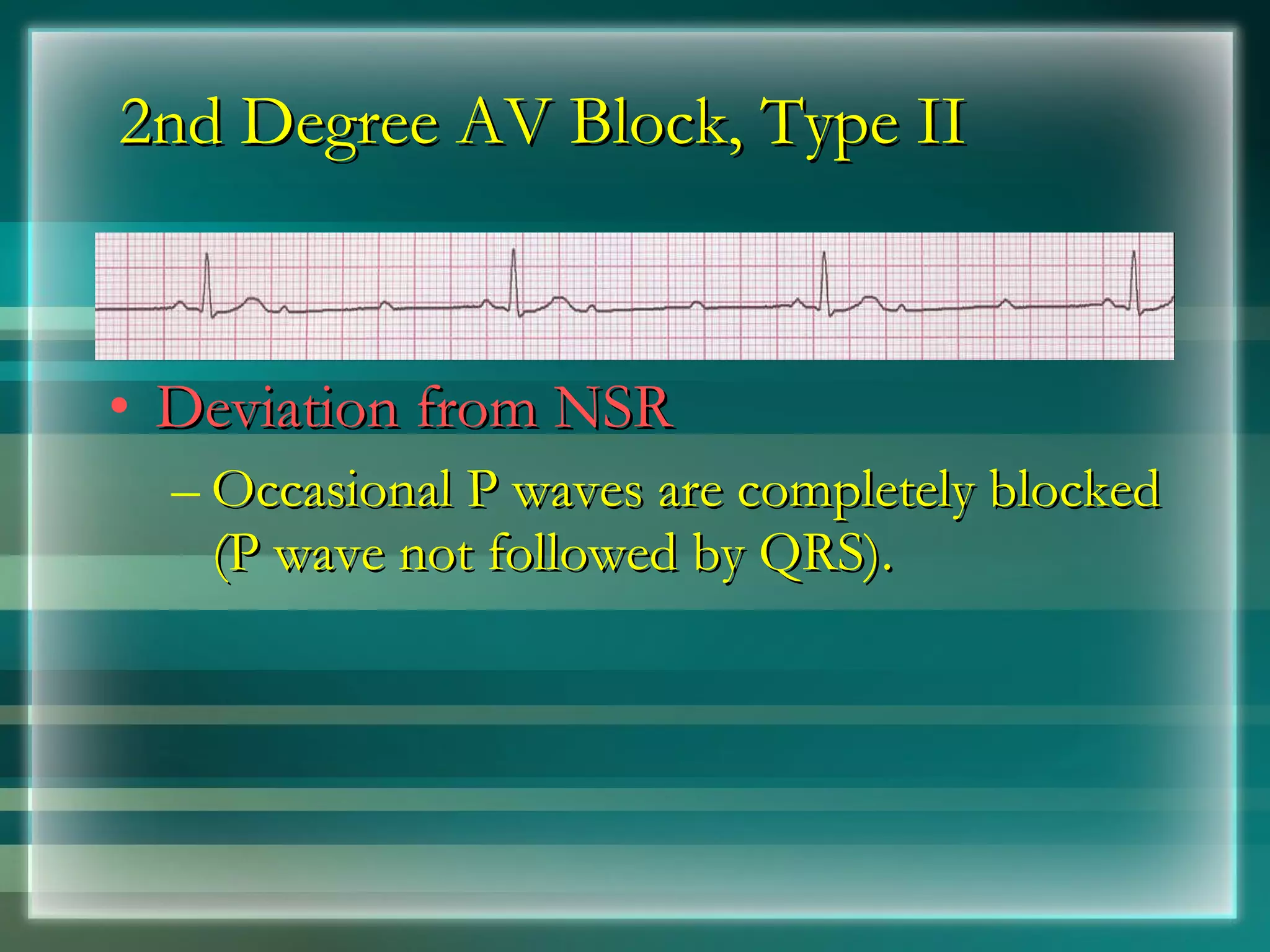 2nd Degree AV Block, Type II Deviation from NSR Occasional P waves are completely blocked (P wave not followed by QRS). 