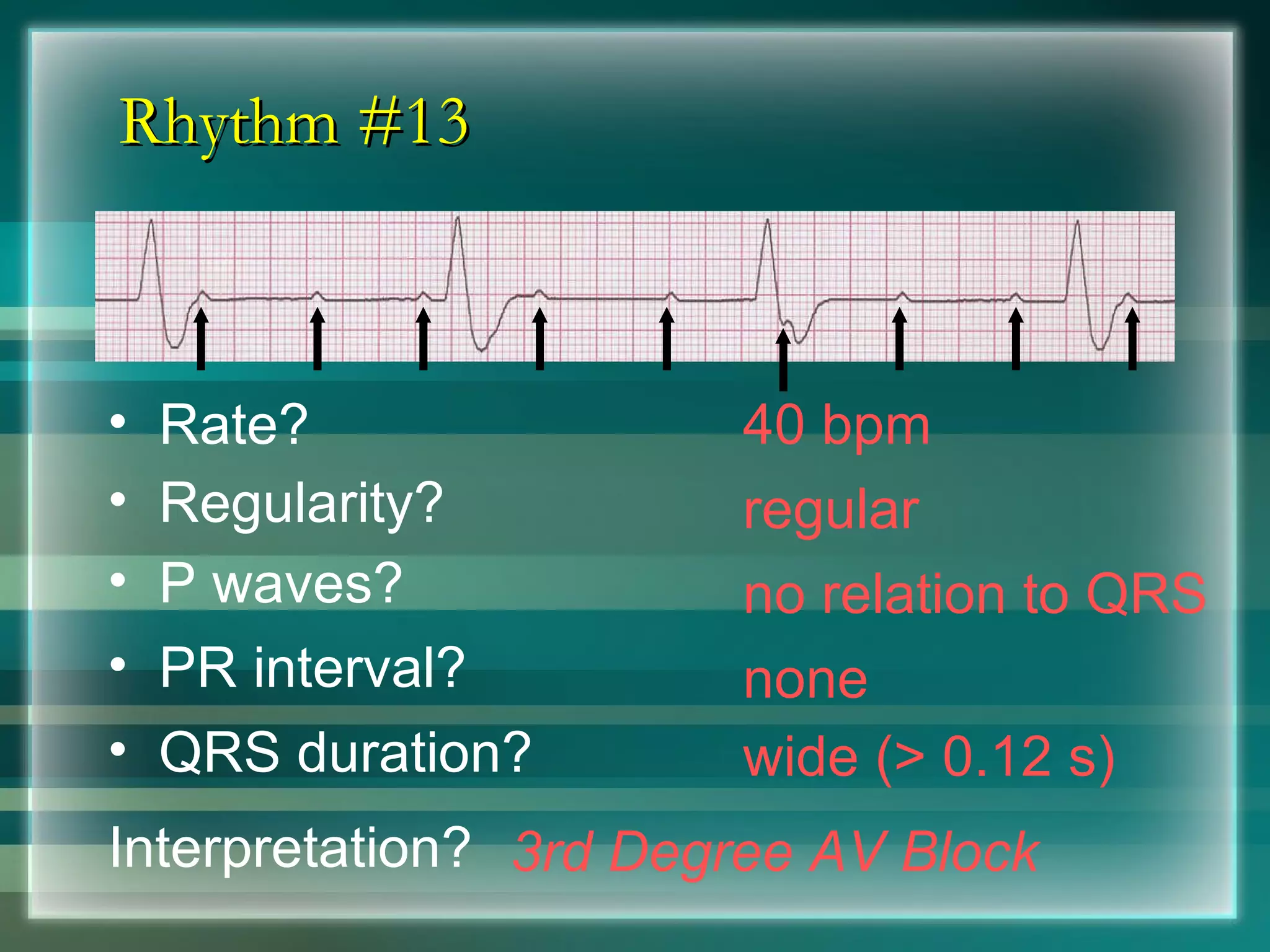Rhythm #13 40 bpm Rate? Regularity? regular no relation to QRS wide (> 0.12 s) P waves? PR interval? none QRS duration? Interpretation? 3rd Degree AV Block 