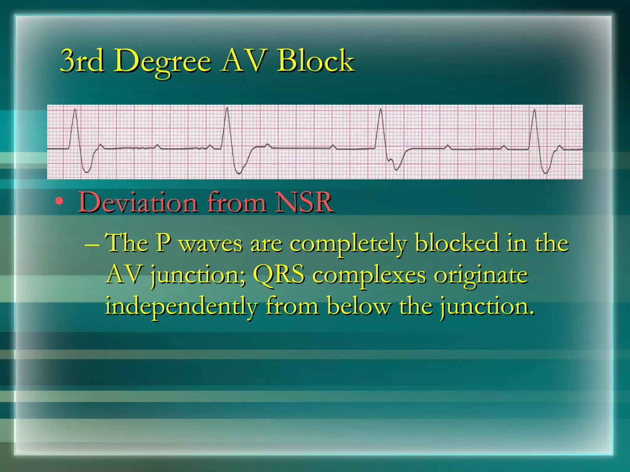 3rd Degree AV Block Deviation from NSR The P waves are completely blocked in the AV junction; QRS complexes originate independently from below the junction. 