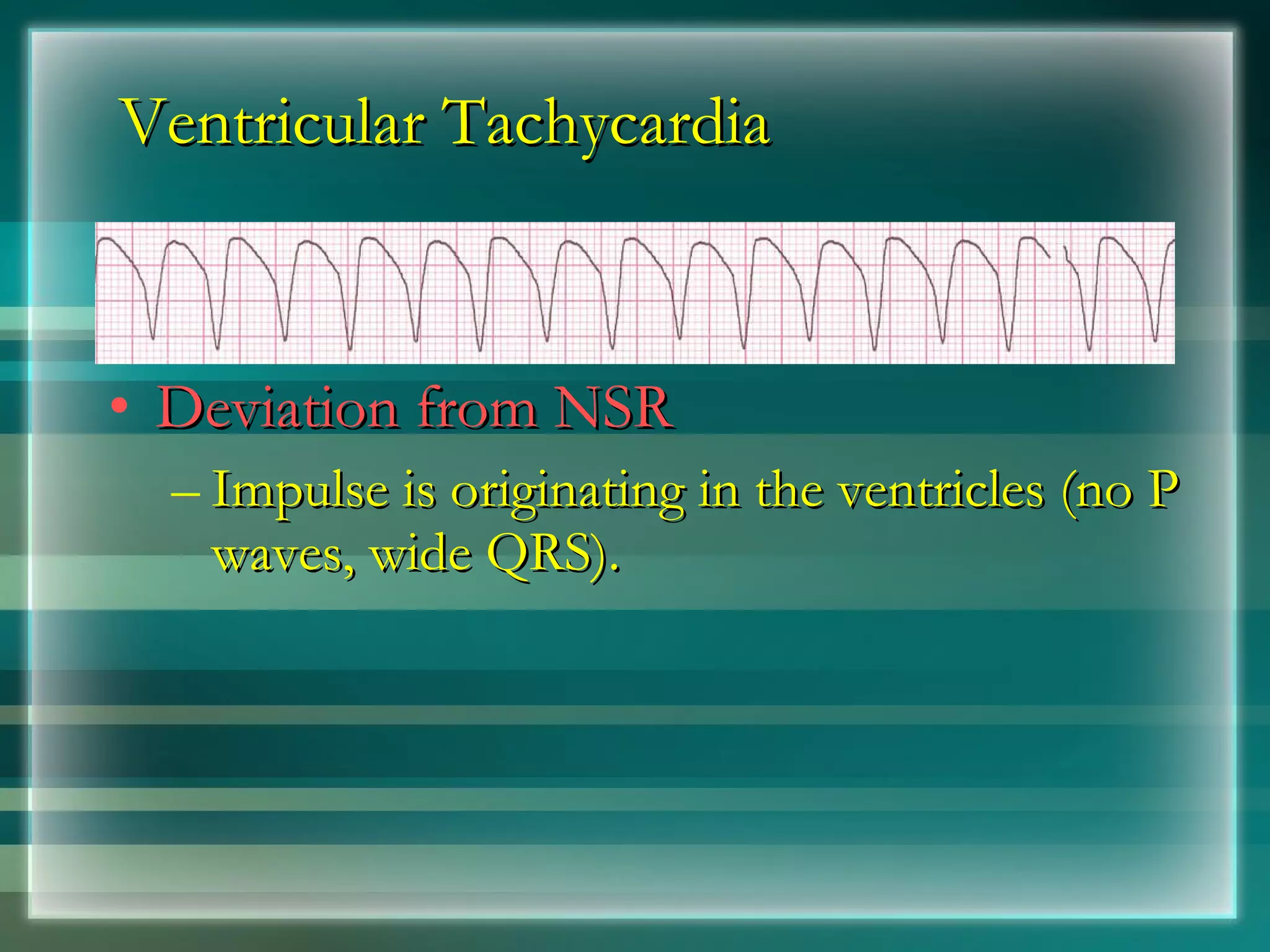 Ventricular Tachycardia Deviation from NSR Impulse is originating in the ventricles (no P waves, wide QRS). 